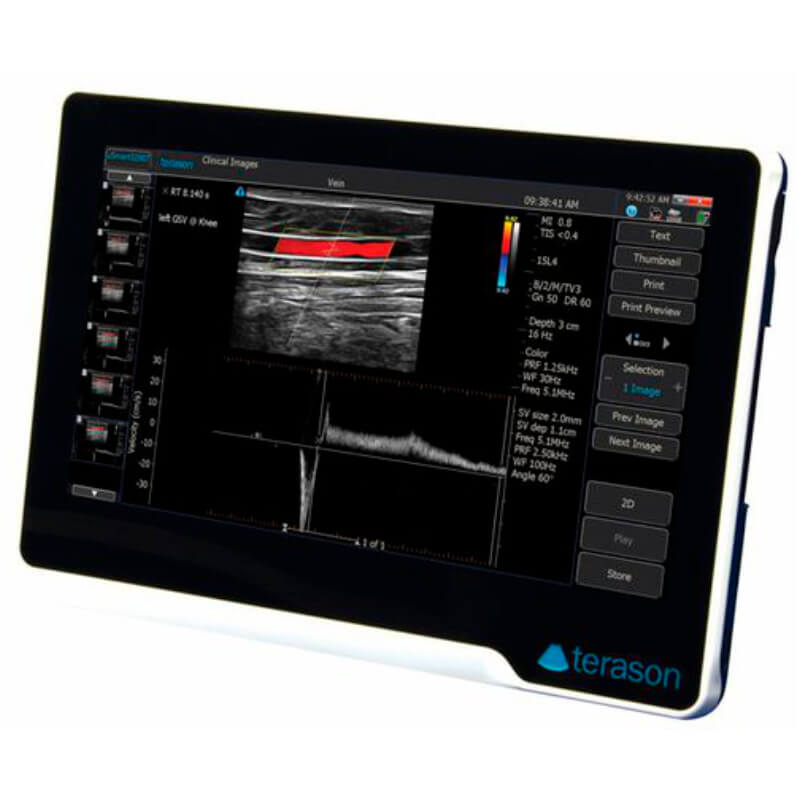 Ecógrafo portátil tipo tablet, doppler color USMART 3200T, Terason